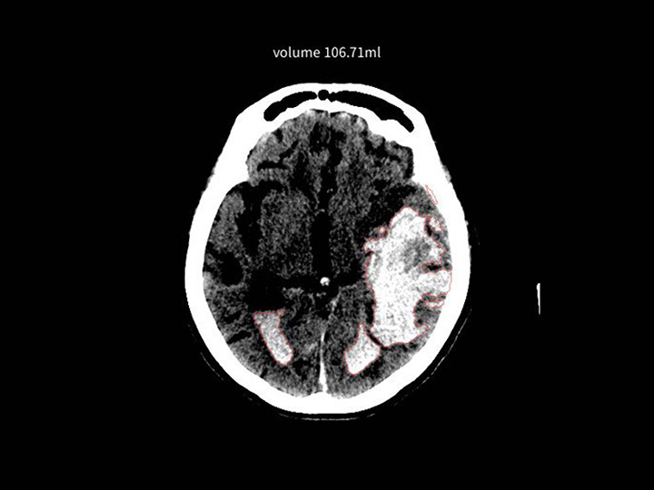 頭部CT×高吸収/低吸収域