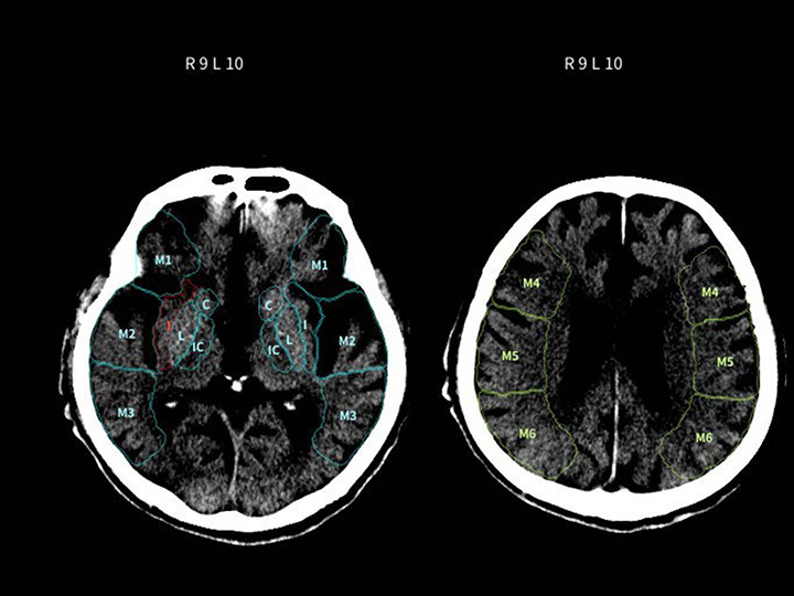 頭部CT×高吸収/低吸収域