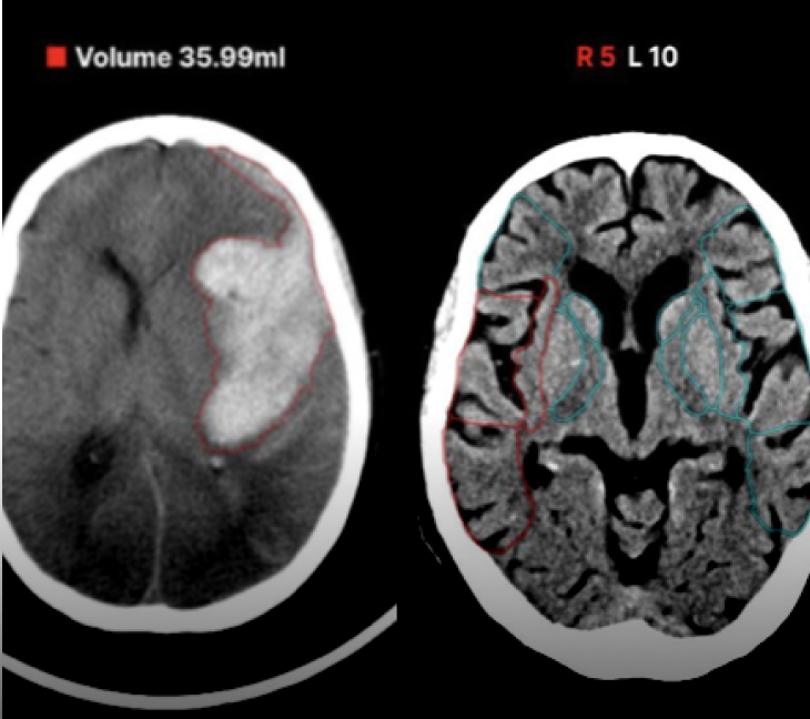 頭部CT×高吸収/低吸収域