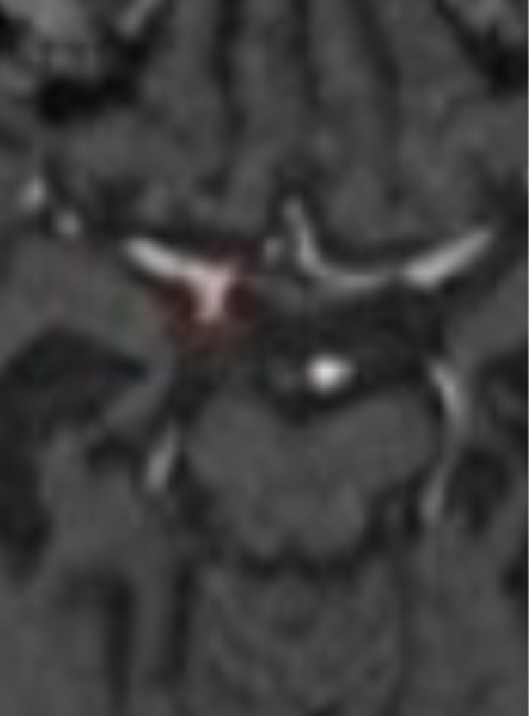 頭部MR×動脈瘤